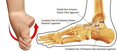 The Running Doctor: Dealing with ankle sprains