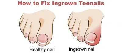 The Running Doctor: Healing ingrown toenails