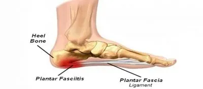 足底筋膜炎解释/原因/症状/诊断/治疗