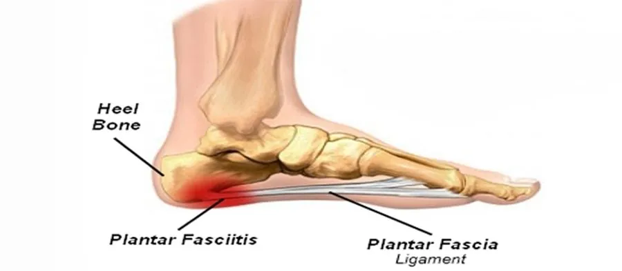 足底筋膜炎解释/原因/症状/诊断/治疗