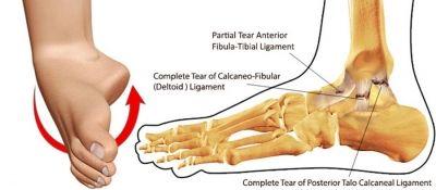 The Running Doctor: Dealing with ankle sprains