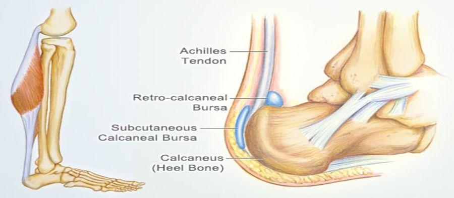 Achilles Tendinosis Sympton, Causes, Treatment