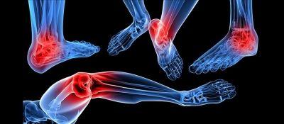 The Running Doctor: Prevention and treatment of Arthritis