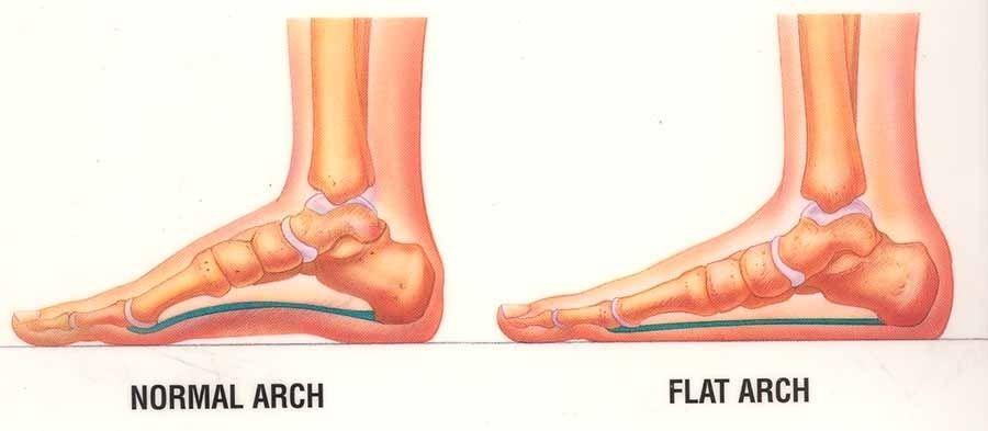 Flat Feet Causes and Prevention